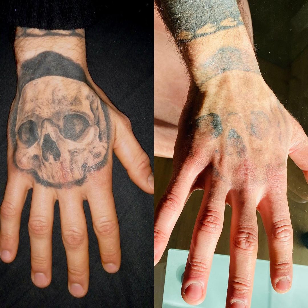 sanar la eliminación de tatuajes