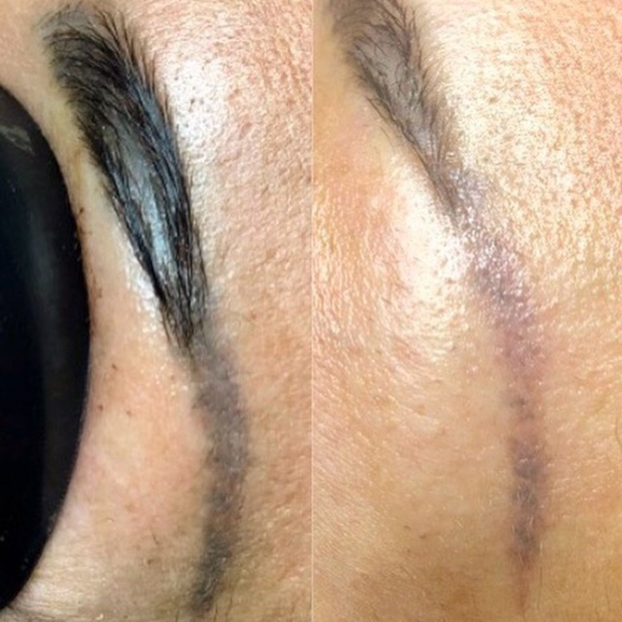 Eliminación de micropigmentación cejas