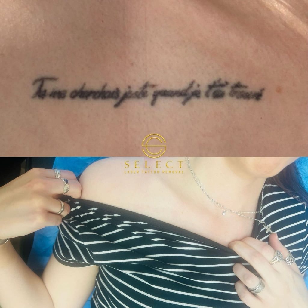 eliminación tatuaje