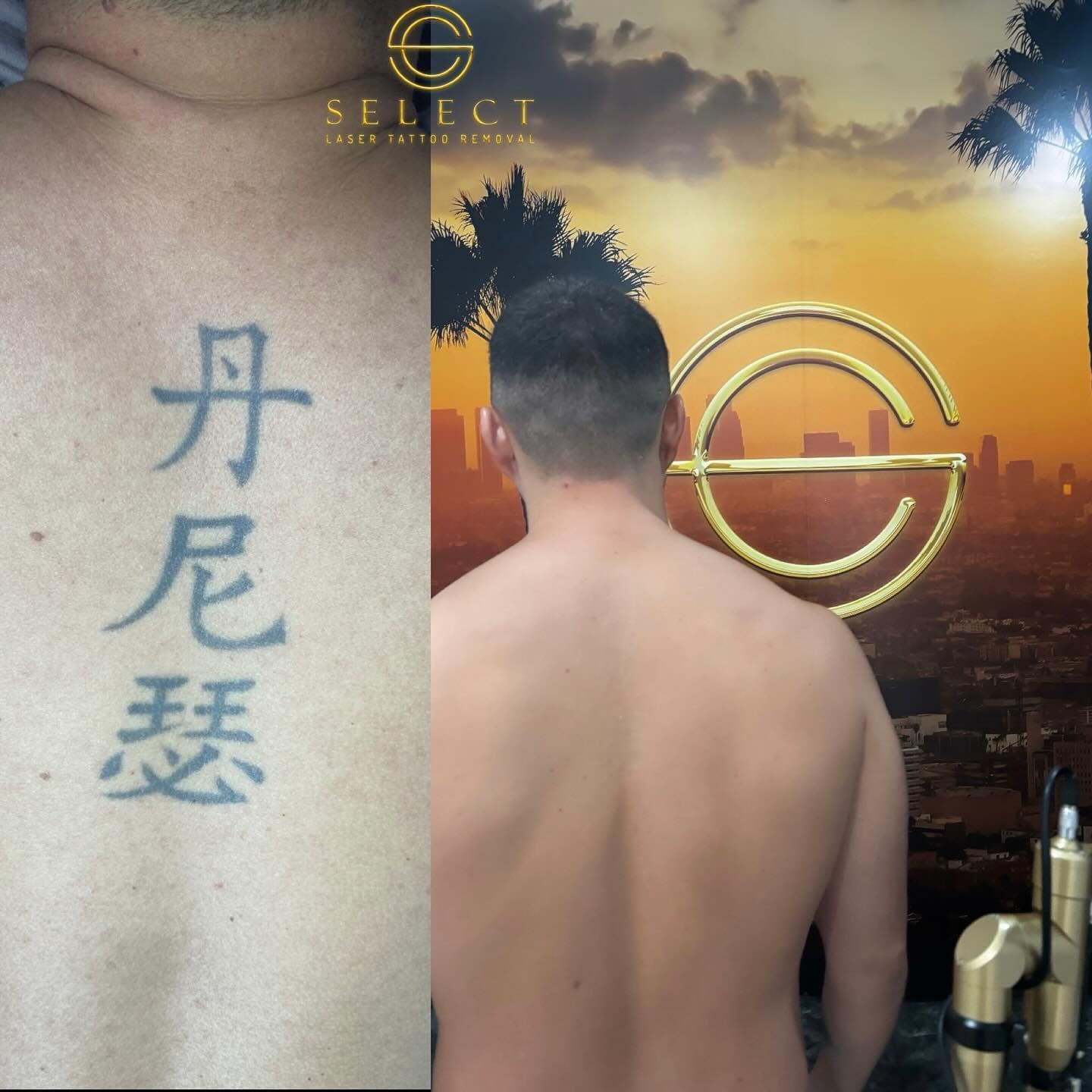 eliminación tatuaje