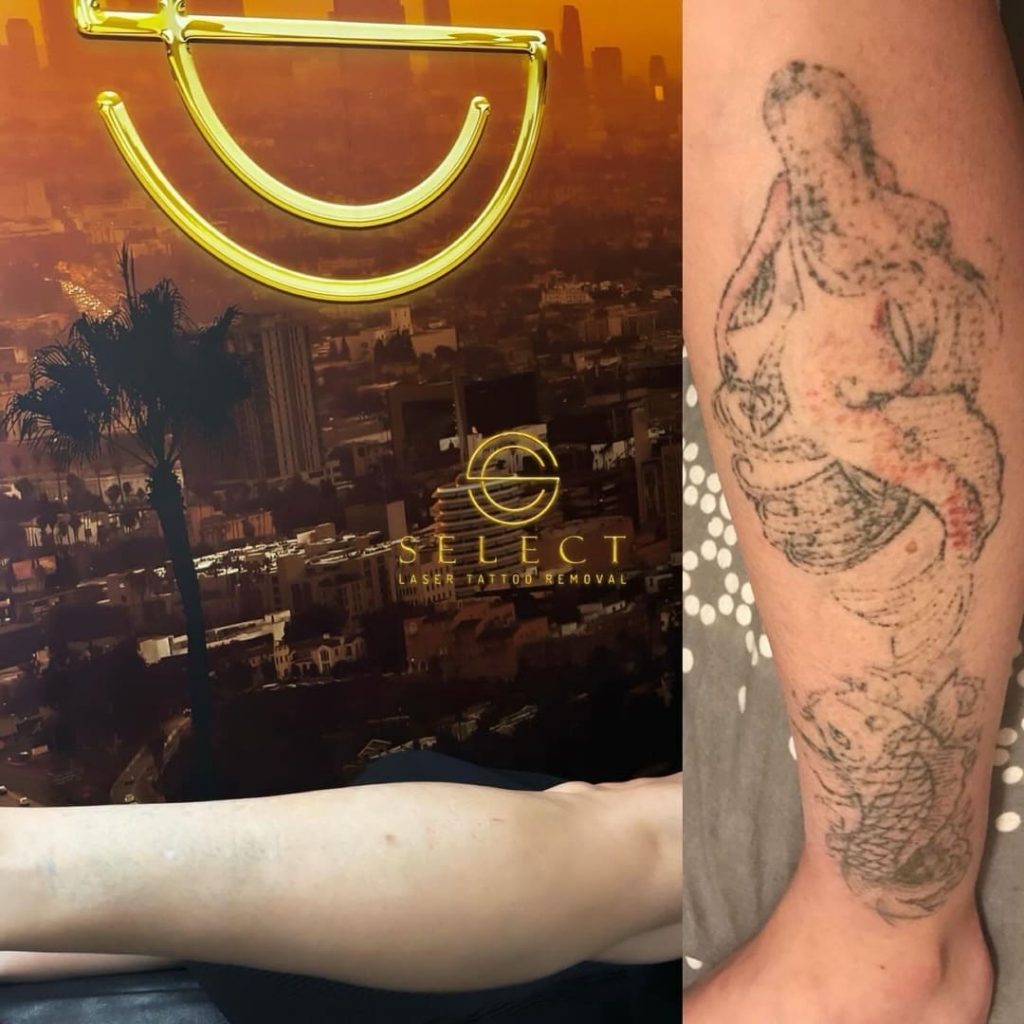 eliminación tatuaje