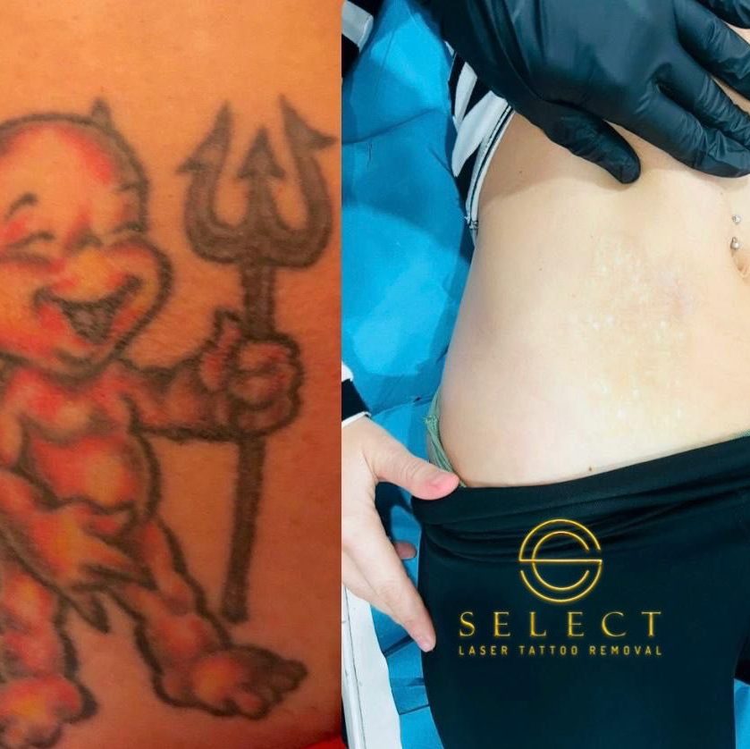 Tatuaje eliminado