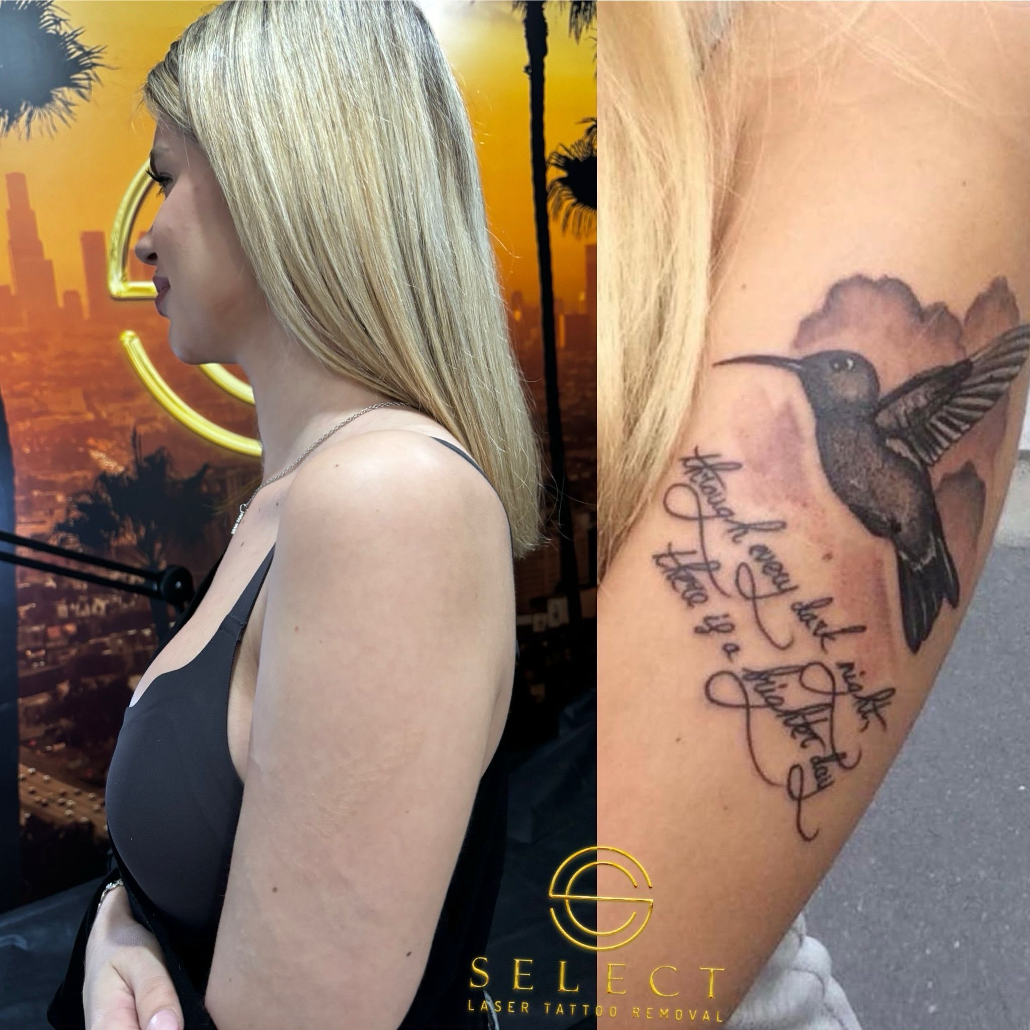 Eliminación de tatuaje en brazo