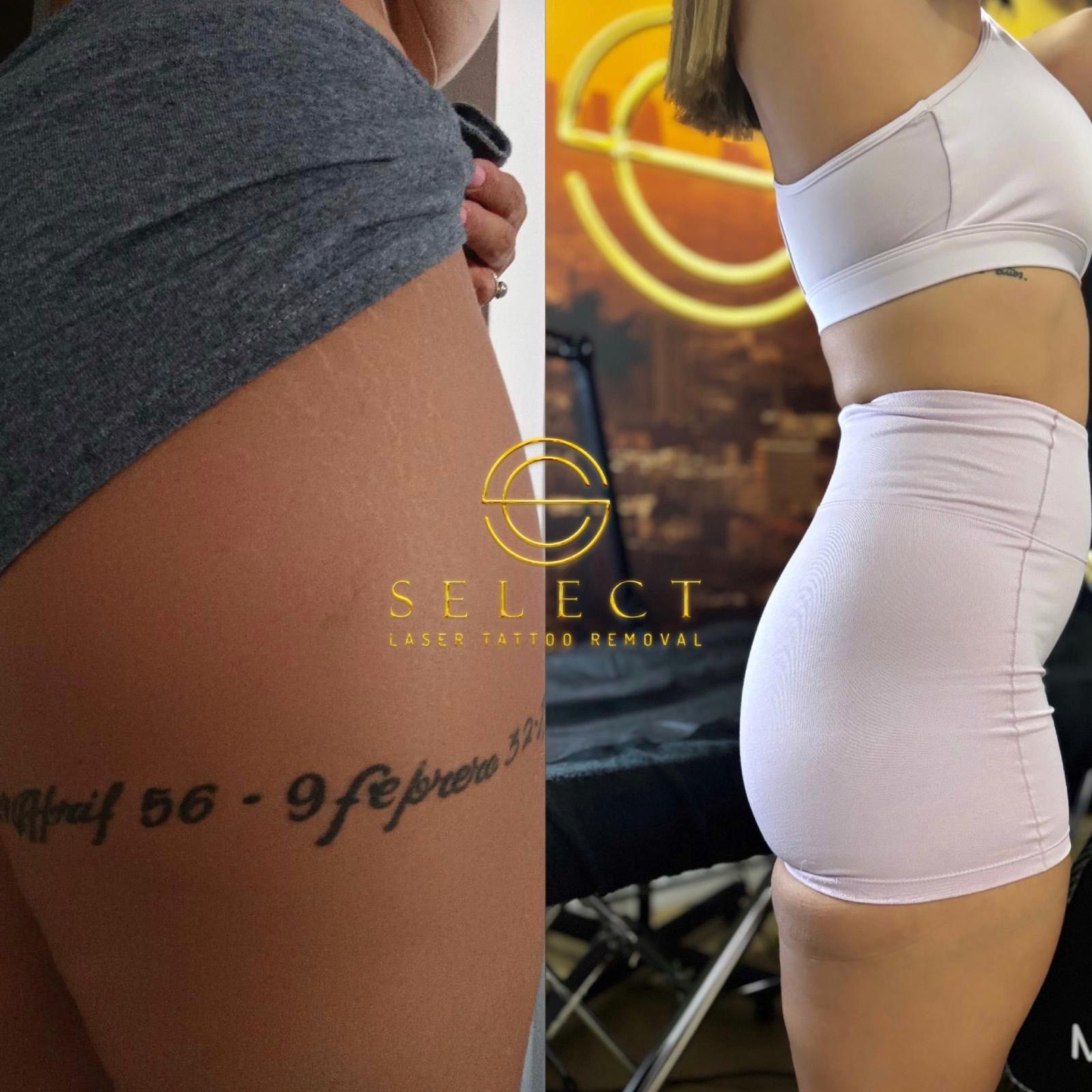 ¿Cómo saber si la eliminación de tatuajes con láser está funcionando?
