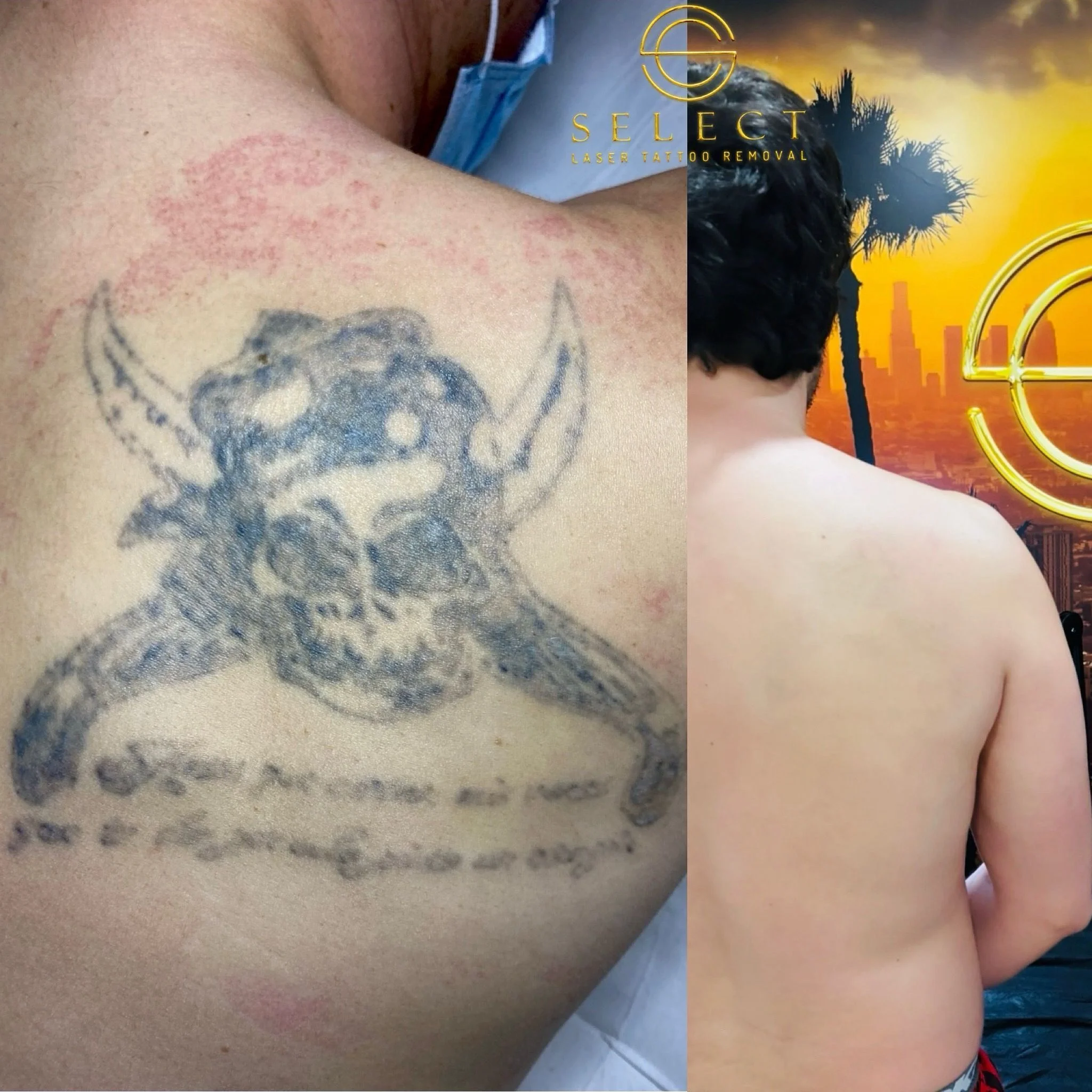Complejos eliminación de tatuajes