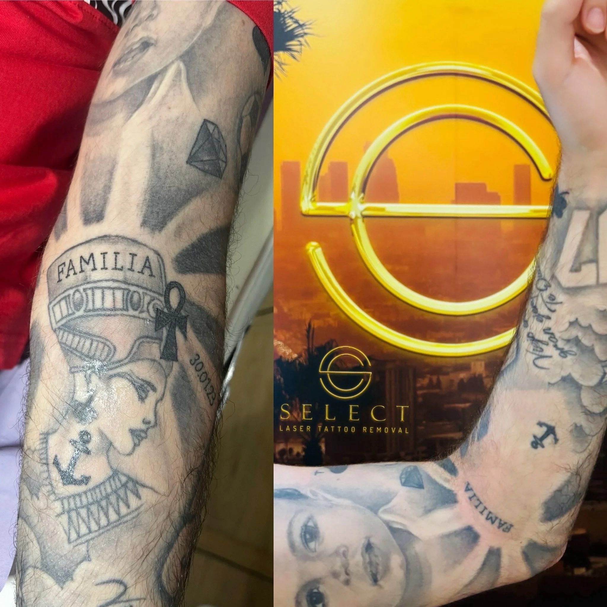 Cuidados después de láser tatuaje