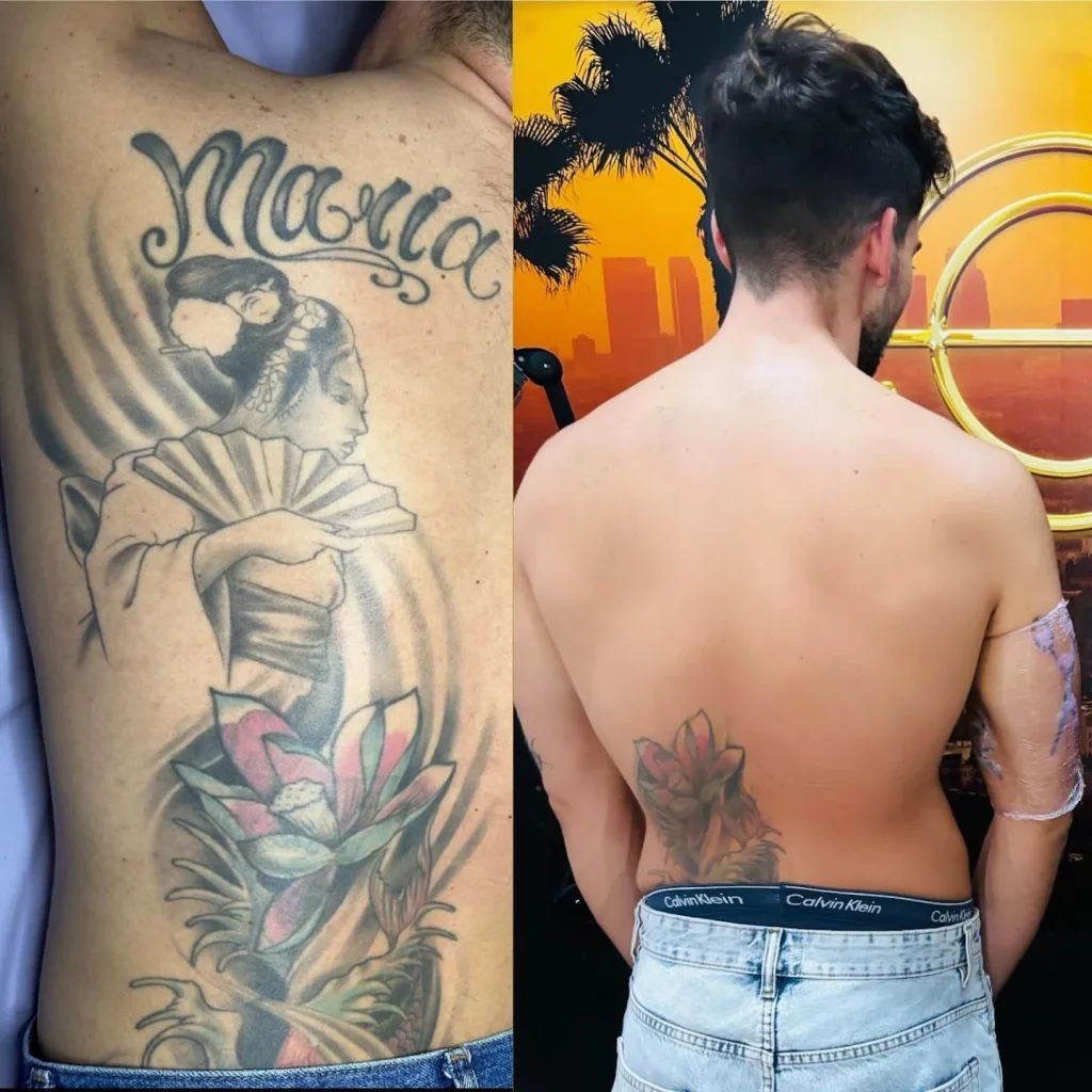 Eliminación tatuaje Madrid