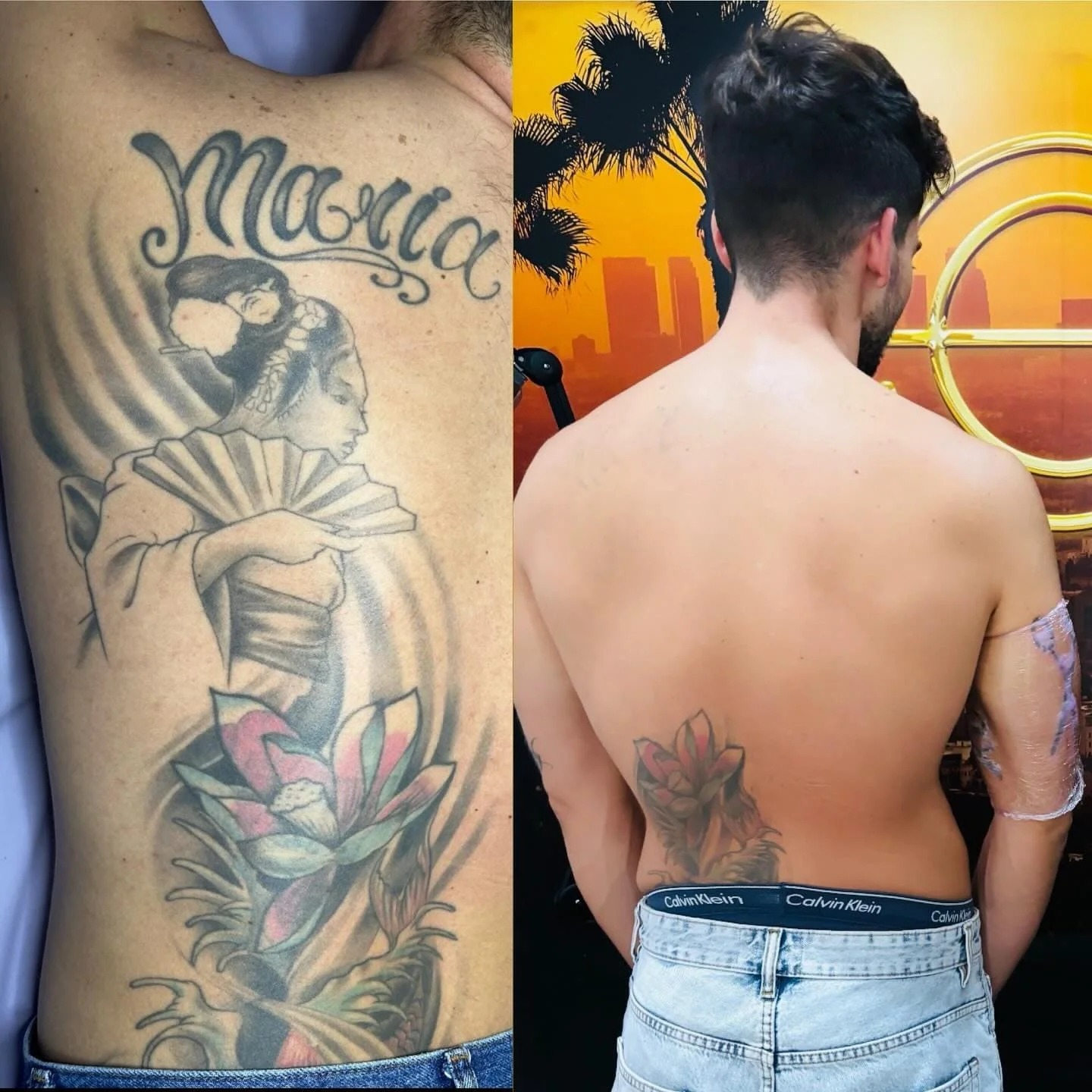 Eliminación tatuaje Madrid