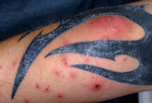 alergia a un tatuaje
